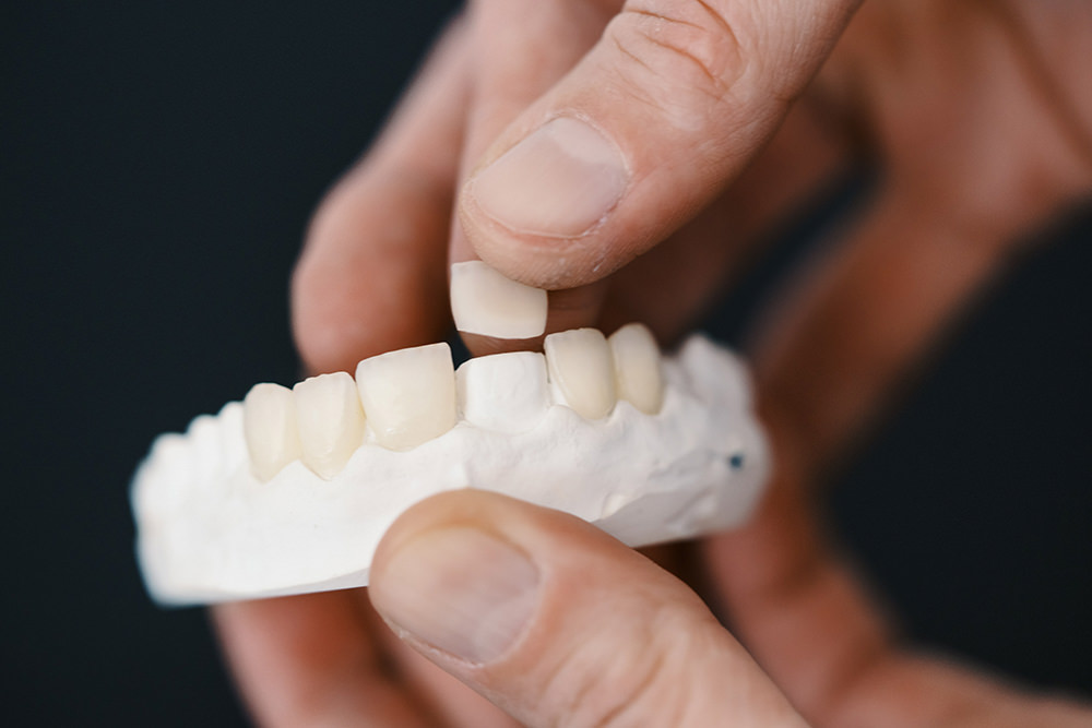 Veneers Zahntechnik Modell Zahnarzt Oberkassel Praxis Prinzenpark